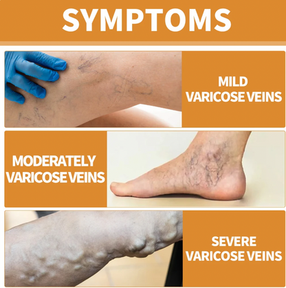 Richavita™ Varicose Veins  Spray
