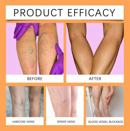 Richavita™ Varicose Veins  Spray